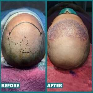 Hair-Transplant-Surgery-in-Lahoreclinic-pnlb5elzzbx05ybqvm0f9d8viqwyknp4omkew2dyu8