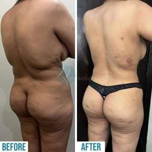 Liposuction 5