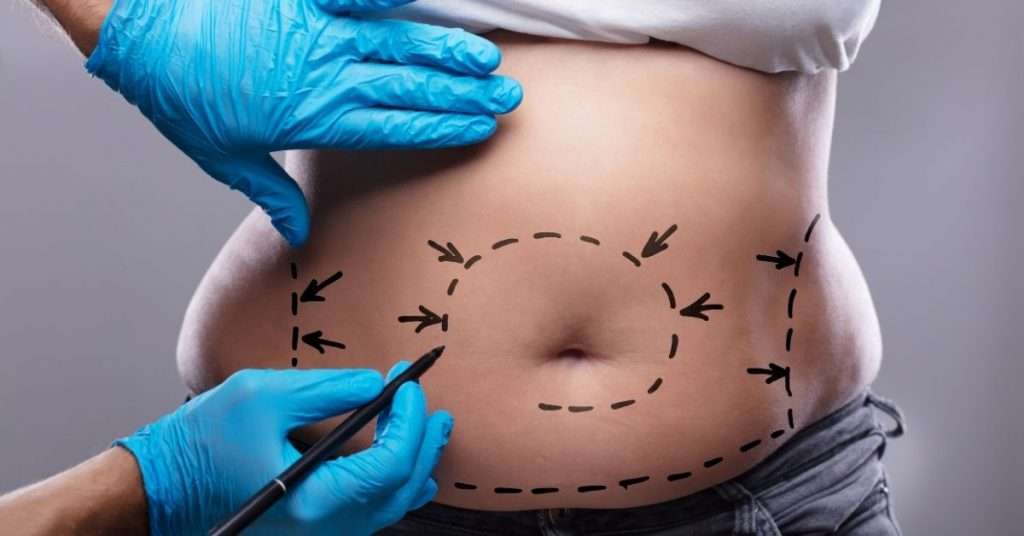 Liposuction Surgery by best cosmetic surgery in pakistan