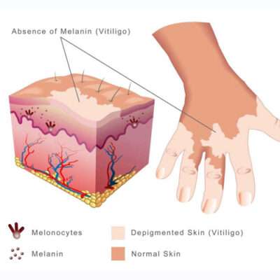 vitiligo-treatment under the cosmetique at lahore Pakistan